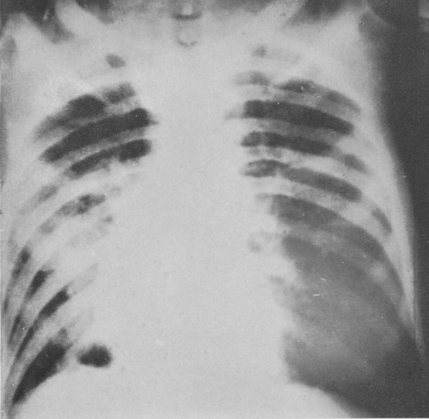 2Type 1, Influenza bronchopneumonia_Viewed as from behind