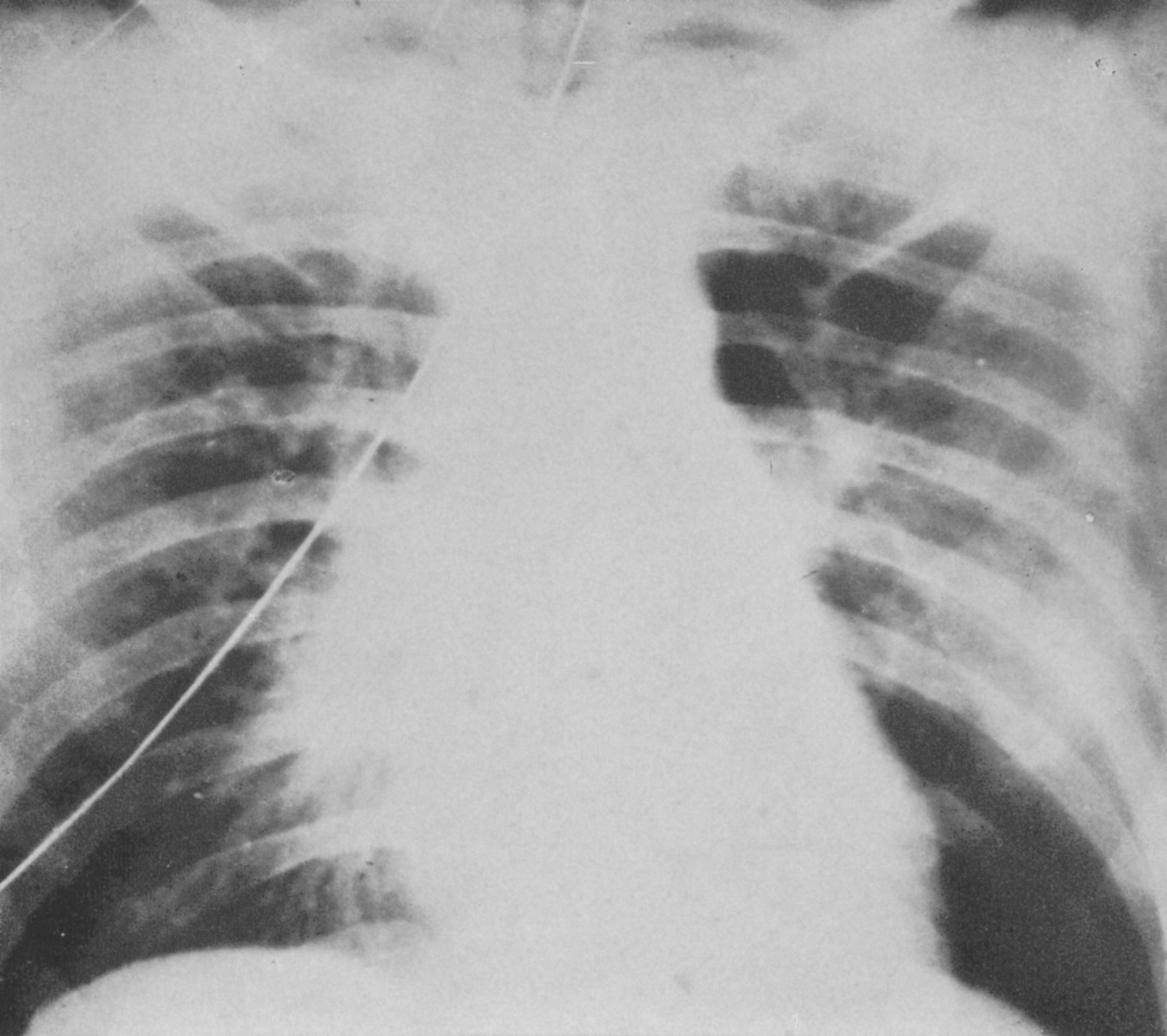 6Type 4, the so-called “critical pneumonia