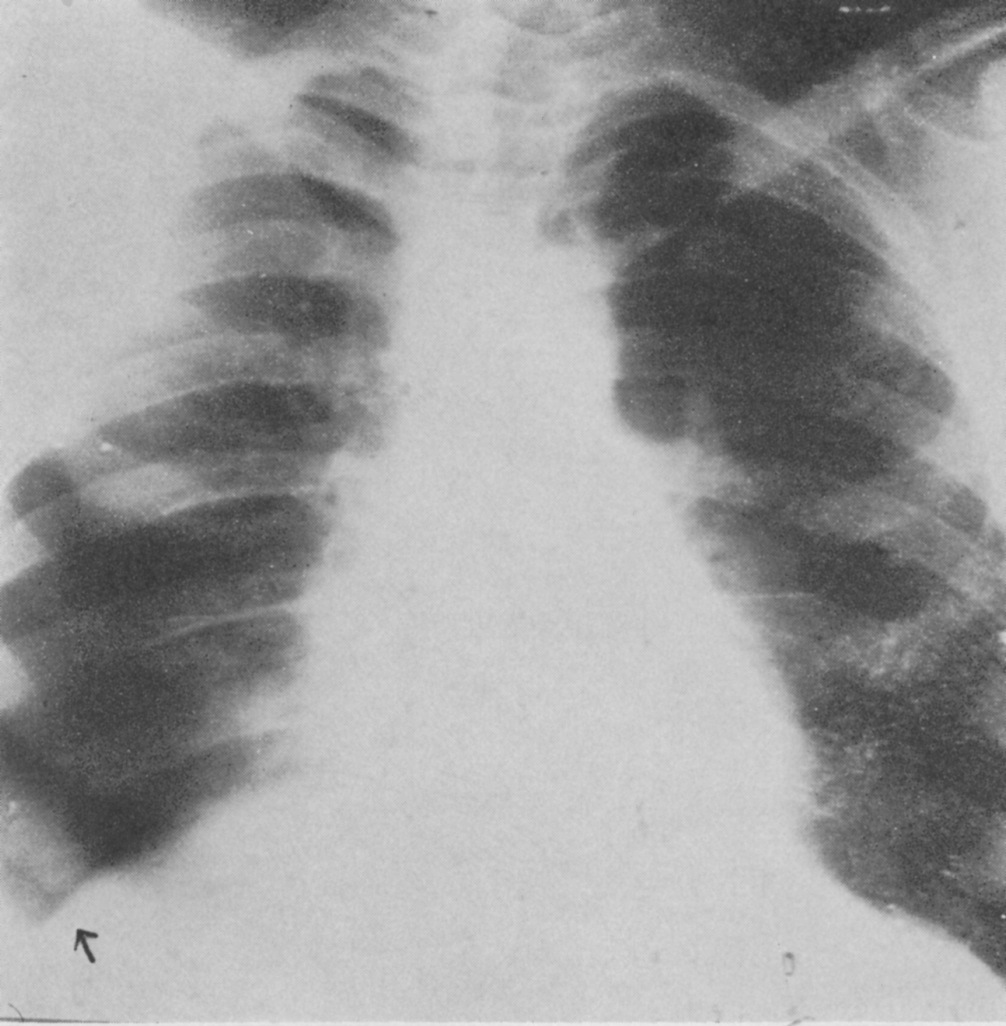 7a Type 5. This started in the dependent part of the lungs