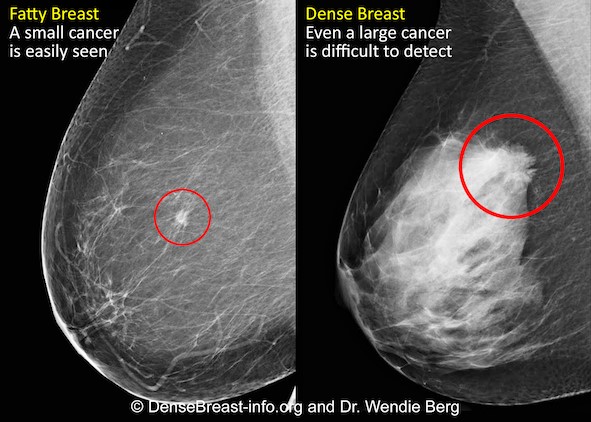Why understanding breast density matters
